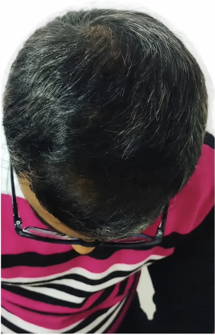 Male Pattern Baldness case 5 after treatment